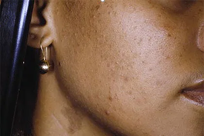 Acne